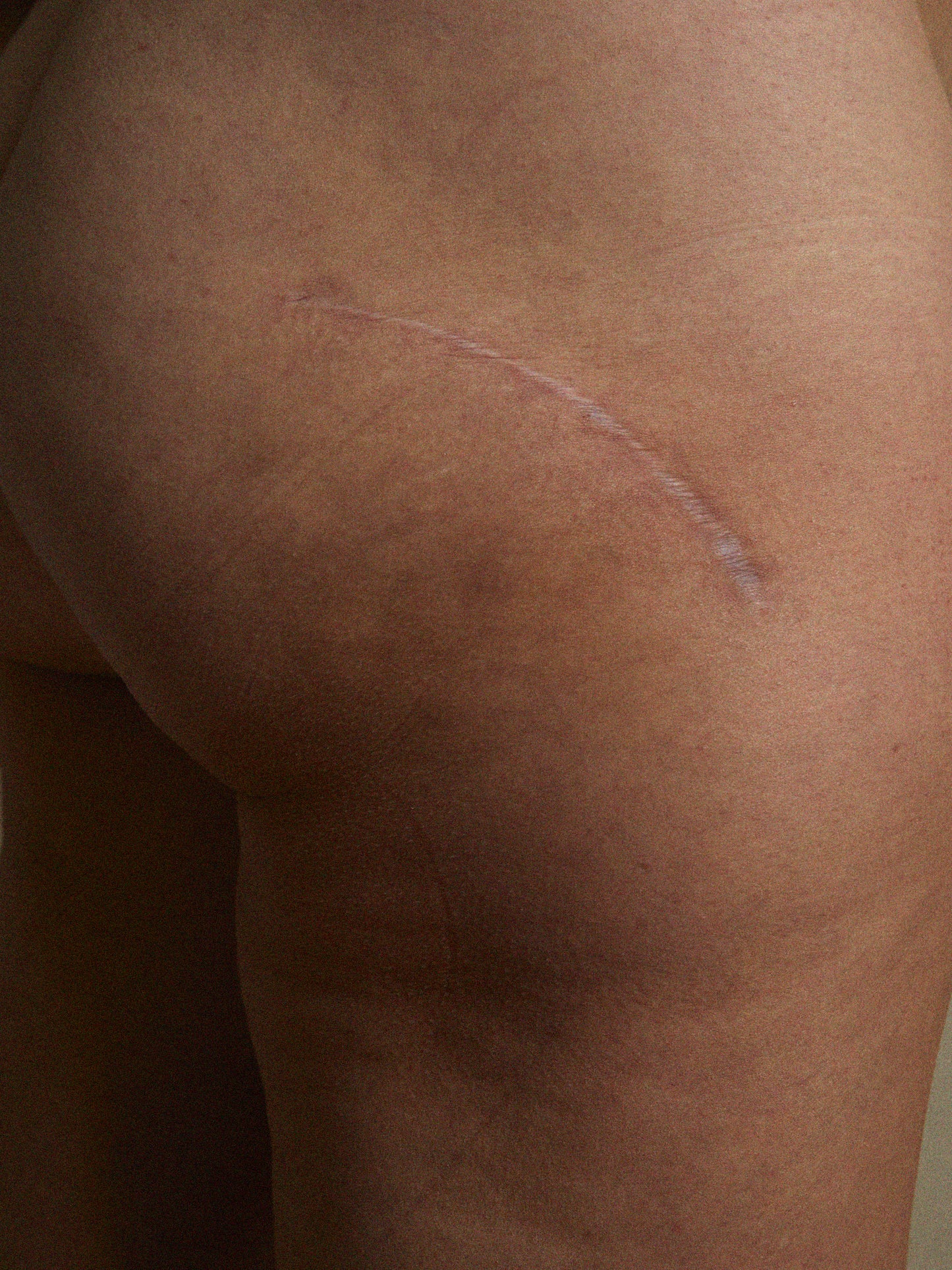 Cicatrice claire sur la hanche d’une femme, peau nue sur fond neutre